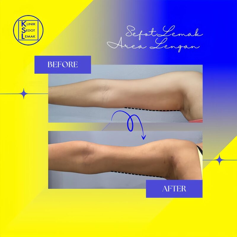 Before After Ginandjar